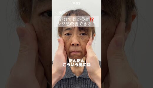 【糸リフト】このシワが激変⁉️#shorts