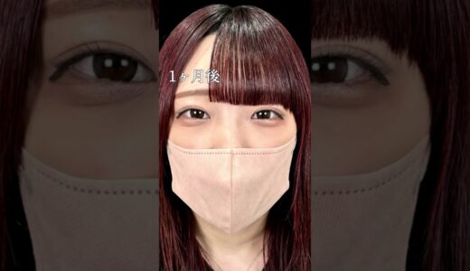 【クマ取り】ぷっくり涙袋出現！#shorts #美容整形 #整形 #美容 #クマ取り