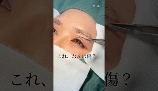 【眉下リフト】傷はこんな感じになります#shorts