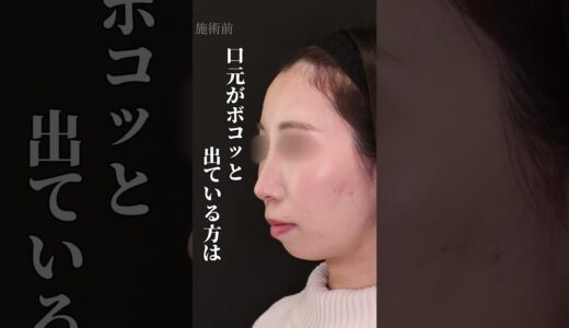 横顔美人の作り方 大公開 #美容整形