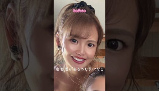 二重整形してきた#美容整形
