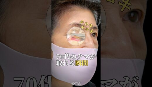 【クマ取り】70代のクマが取れる瞬間#shorts