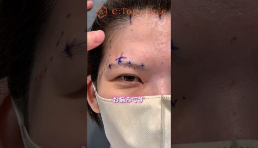 内視鏡前額リフト症例🌟#美容整形