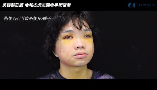 【美容整形版 令和の虎】Xジェンダーとして生きる、決意の手術に密着