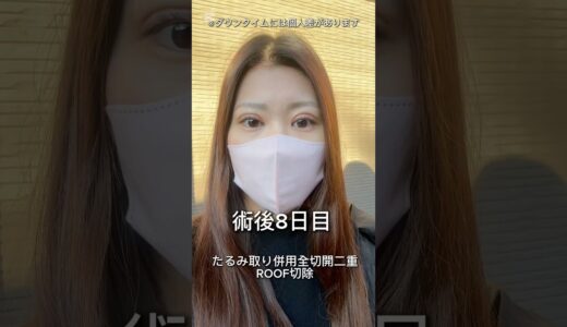 全切開二重ダウンタイム経過#美容 #美容整形 ＃全切開二重