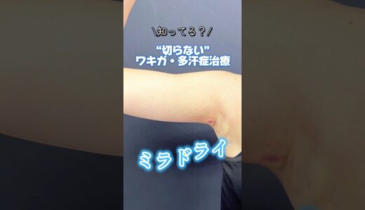 今なら15%OFFのキャンペーン実施中！#美容整形 #美容 #垢抜け #ミラドライ #脇汗 #脇汗対策 #ワキガ #ワキガ対策 #多汗症 #多汗症治療 #ワキガ治療 #湘南美容クリニック #sbc