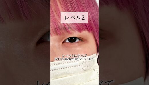 【二重整形】あなたの蒙古襞レベルはどれ？#shorts