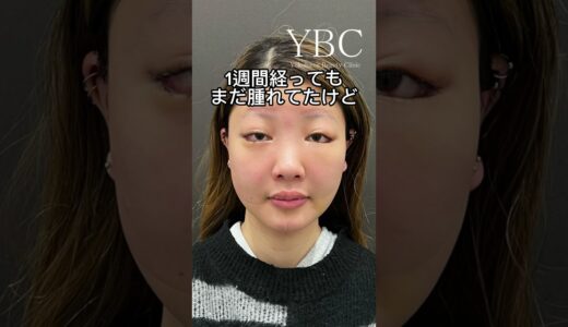 全顔整形したら