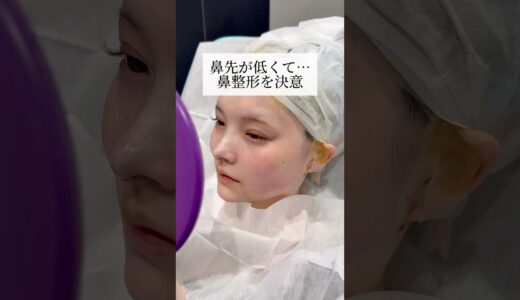 【鼻整形】鼻先が低くて鼻整形を決意#shorts