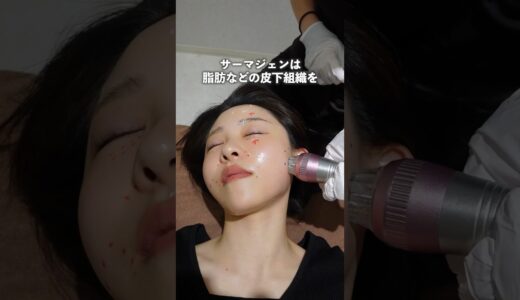【後編】大本命「サーマジェン」レポ#サーマジェン#ハイフ#美容医療#たるみ治療#シワ改善#HIFU#美容クリニック#アラサー#30代#エイジング#エイジングケア