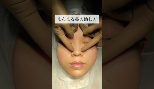 【鼻整形】まんまる鼻の治し方#shorts