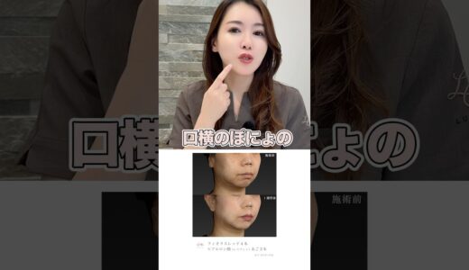 NEW糸リフト【フィオラスレッド】#美容整形 #糸リフト #スレッドリフト