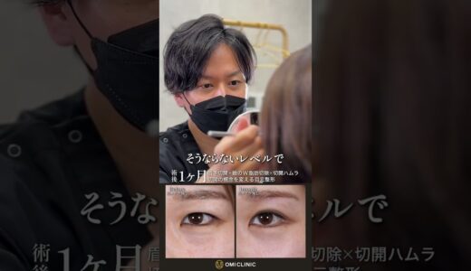 切開でしか叶わない大激変！#美容クリニック #美容整形 #眉下切開 #切開ハムラ