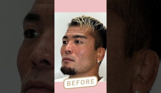 【二重埋没】総合格闘家が初めて美容整形を受けてみた！ #shorts #二重整形 #格闘技 #武田光司 さん