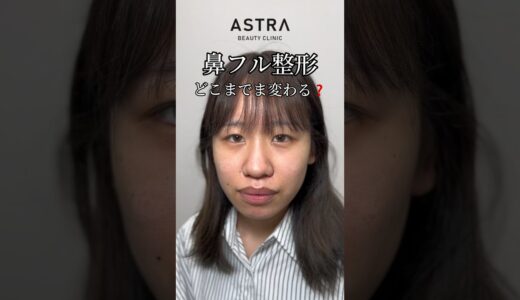 鼻フルしたらどれくらい変わる❓#アストラビューティークリニック #astrabeautyclinic #塩満先生 #塩満恵子 #忘れ鼻 #鼻整形 #鼻整形ダウンタイム #垢抜け #美容外科 渋谷