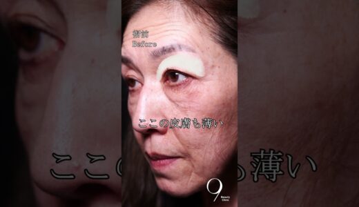 表ハムラと眉下切開でシワは消える‼️ #クマ取り #クマ治療 #眉下リフト #眉下切開 #表ハムラ #表ハムラ法