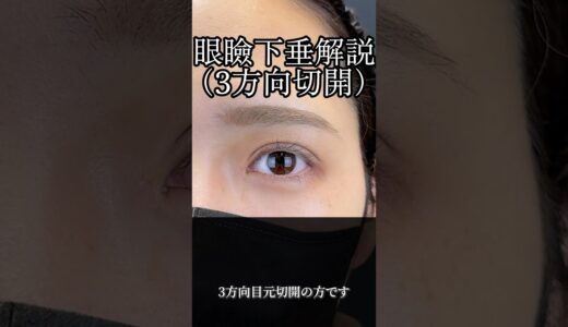 眼瞼下垂解説(3方向切開) #二重整形 #美容整形