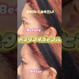 【大人気】カスタマイズヒアルロン酸#ヒアルロン酸注射 #美容整形