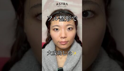 フル整形で大成功💖#astrabeautyclinic  #アストラビューティークリニック #塩満恵子 #鼻整形 #美容整形 #忘れ鼻