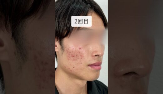 【肌治療】大人気施術ポテンツァ7回経過すべてお見せします！#美容外科 #美容整形 #美容クリニック #整形 #ニキビ跡 #ニキビ