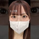 【クマ取り】ぷっくり涙袋出現！#shorts #美容整形 #美容 #整形 #クマ取り