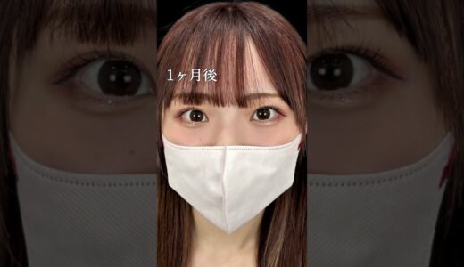 【クマ取り】ぷっくり涙袋出現！#shorts #美容整形 #美容 #整形 #クマ取り