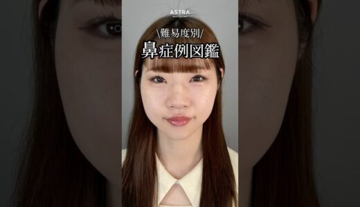 【難易度高め鼻症例図鑑🤫#忘れ鼻#鼻整形#鼻尖形成#耳介軟骨移植#鼻プロテーゼ#小鼻縮小#だんご鼻#団子鼻#塩満先生#アストラビューティークリニック#astrabeautyclinic#渋谷】