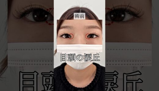 【二重整形】目頭を切るとどうなる？#shorts