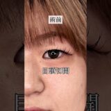【二重整形】目頭を切って映える目に大変身！#shorts