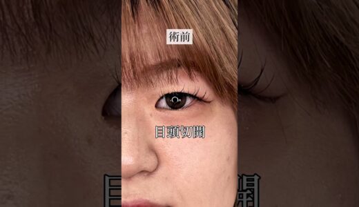 【二重整形】目頭を切って映える目に大変身！#shorts