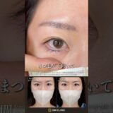 まつ毛の向きを変える私の目元整形#美容整形 #目元整形#美容クリニック
