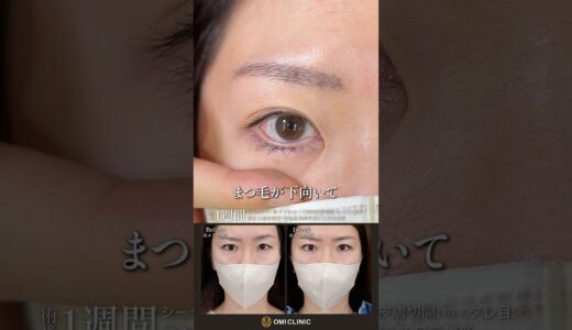まつ毛の向きを変える私の目元整形#美容整形 #目元整形#美容クリニック