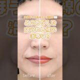 この方のほうれい線治療は何？ #整形 #ほうれい線 #美容 #美容整形 #おすすめに乗りたい #クイズ