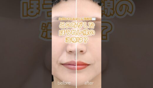 この方のほうれい線治療は何？ #整形 #ほうれい線 #美容 #美容整形 #おすすめに乗りたい #クイズ