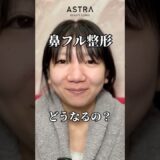 鼻フルでどう変わる？😧🩵#astrabeautyclinic  #アストラビューティークリニック #塩満恵子 #鼻整形 #美容整形 #忘れ鼻