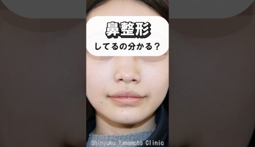 鼻整形、してるの分かる？？#鼻整形 #他院修正 #美容整形 #小鼻縮小 #shortvideo #鼻尖形成 #外側人中短縮 #shorts #short #新宿山本クリニック #鼻中隔延長 #鼻フル