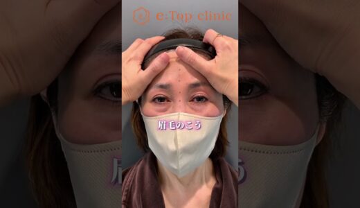 前額リフトデザイン解説🪄#美容整形 #前額リフト #アンチエイジング