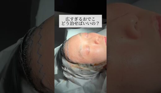 【整形】広すぎるおでこどう治す？#shorts