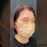アラフィフ女性、YouTube視聴者さん⭐︎美容整形初体験⭐︎眉下＋くまとり＋脂肪注入