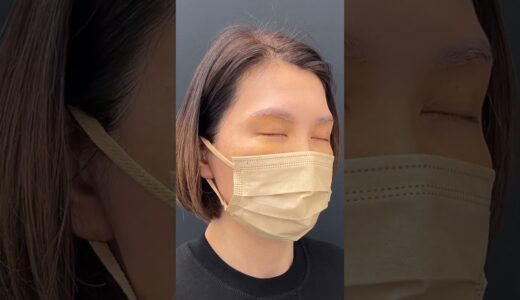 アラフィフ女性、YouTube視聴者さん⭐︎美容整形初体験⭐︎眉下＋くまとり＋脂肪注入