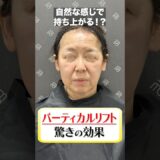 このお肉持ち上がる？#糸リフト #糸リフト効果 #美容 #美容整形 #整形 #たるみ #たるみ改善 #shorts