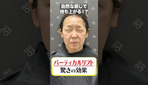 このお肉持ち上がる？#糸リフト #糸リフト効果 #美容 #美容整形 #整形 #たるみ #たるみ改善 #shorts