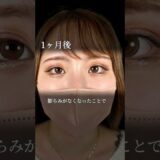 【クマ取り】ナチュラルに垢抜け！#shorts #美容整形 #美容 #整形 #クマ取り