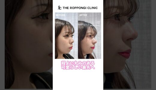 【ザロクの鼻治療で口元の突出感改善】