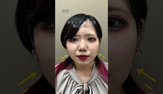 【小顔整形】美容整形でどこまで変わる？#shorts