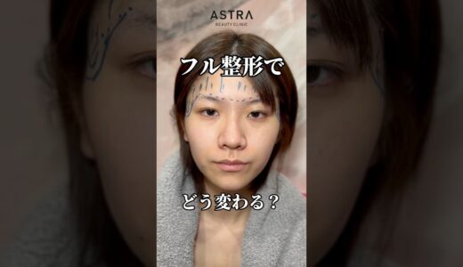 フル整形でどう変わる？👩🏼‍⚕️✨#astrabeautyclinic  #アストラビューティークリニック #塩満恵子 #鼻整形 #美容整形 #忘れ鼻