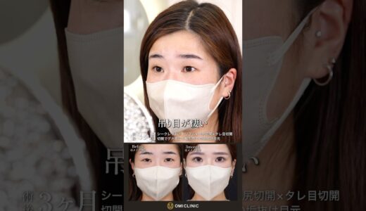 加工アプリを超えるデカ目整形#美容整形 #美容クリニック #二重整形 #名古屋