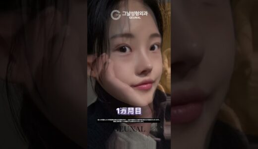 自分の顔にぴったり合うナチュラルな鼻ラインを実現｜自家肋軟骨でバレずに美しく｜クナル美容外科