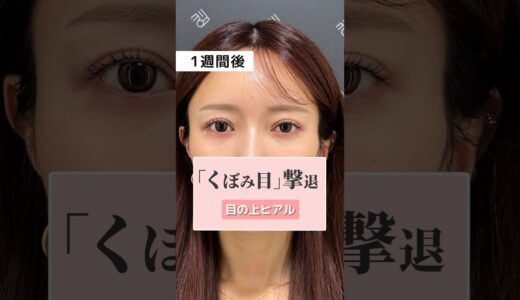 こちらの美女がやった施術は？#ヒアルロン酸 #美容 #美容整形 #小顔 #整形 #糸リフト #shorts