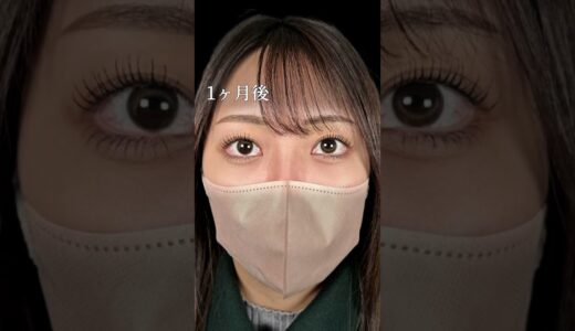 【クマ取り】第一印象が変わる！#shorts #美容整形 #美容 #整形 #クマ取り